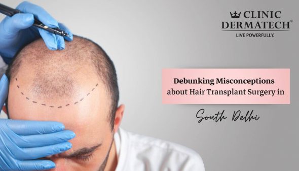 Debunking Misconceptions about Hair Transplant Surgery in South Delhi