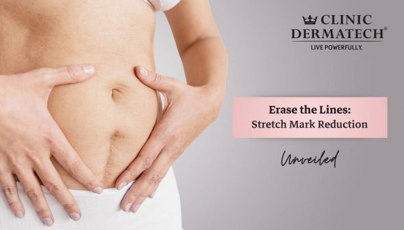 Erase the Lines: Stretch Mark Reduction Unveiled