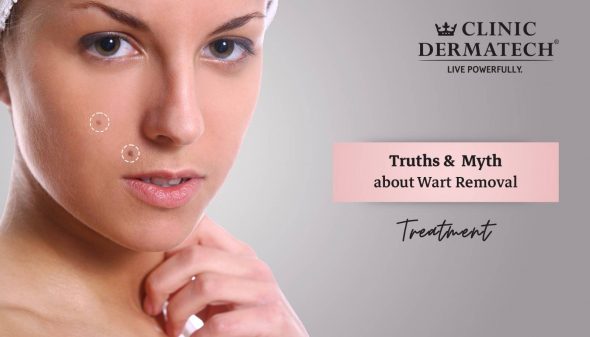 Truths &  Myth about Wart Removal Treatment