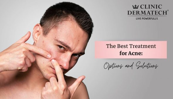The Best Treatment for Acne: Options and Solutions