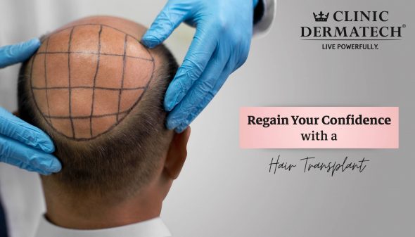 Regain Your Confidence with a Hair Transplant