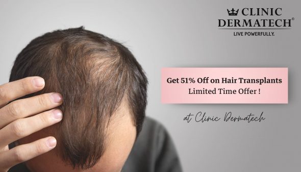 Get 51% Off on Hair Transplants – Limited Time Offer at Clinic Dermatech!