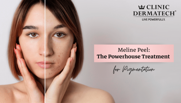 Meline Peel: The Powerhouse Treatment for Pigmentation