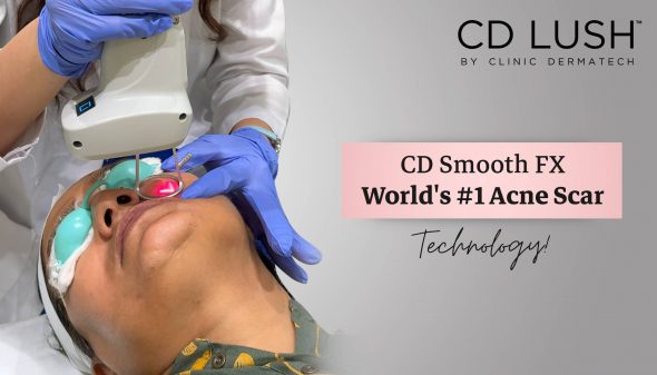 CD Smooth FX- World’s #1 Acne Scar Technology