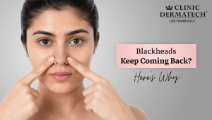 Blackheads Keep Coming Back? Here’s Why