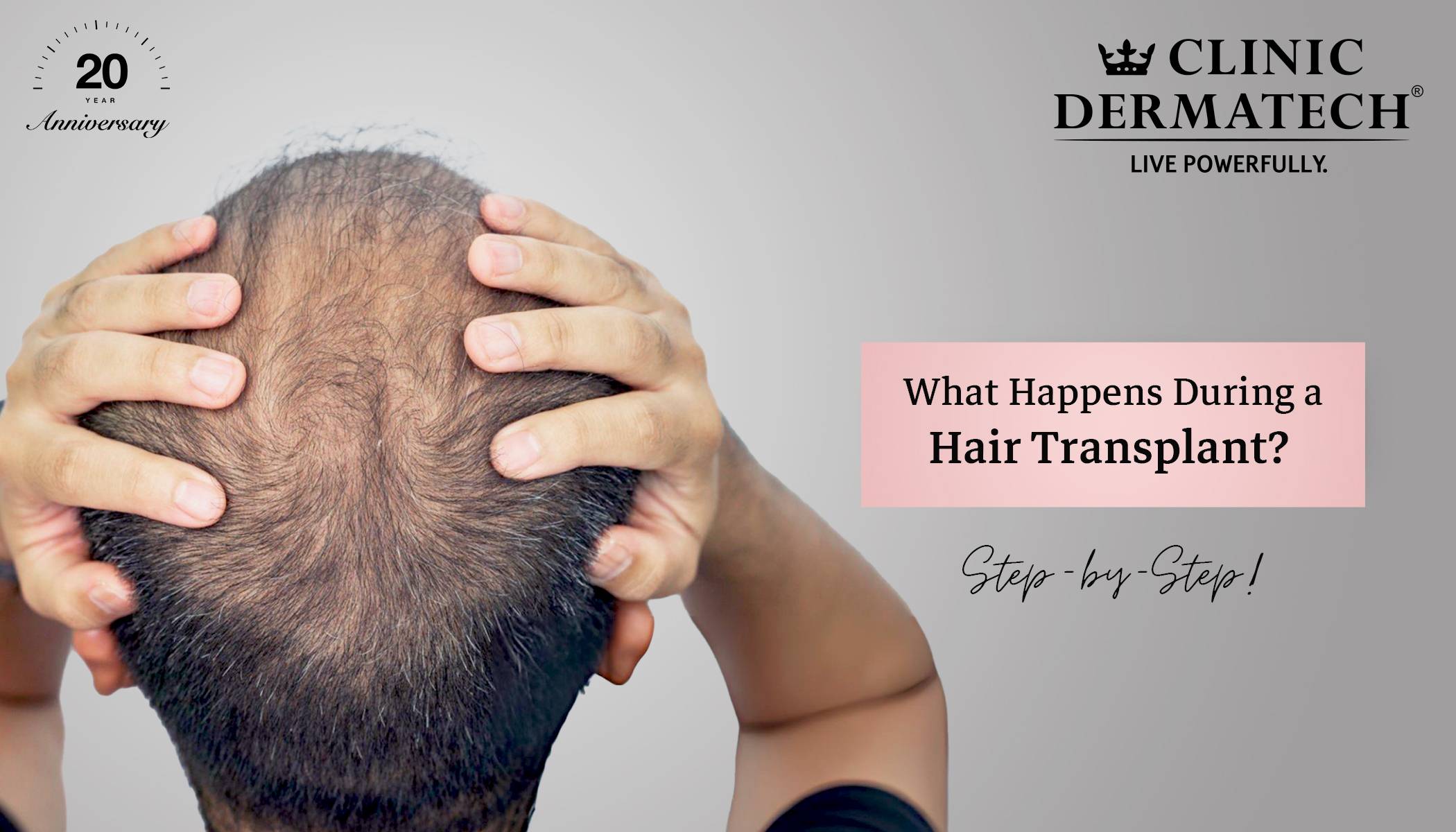 What Happens During a Hair Transplant? Step-by-Step