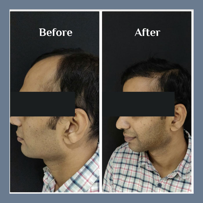 Hair Transplant procedure