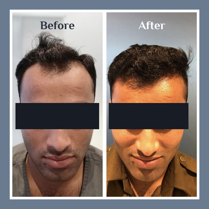 Hair Transplant procedure