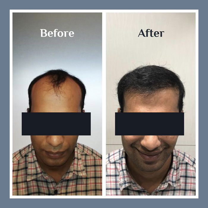Hair Transplant procedure
